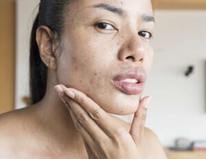 Votre peau purge-t-elle les rétinoïdes ?  Voici ce qu'il faut savoir