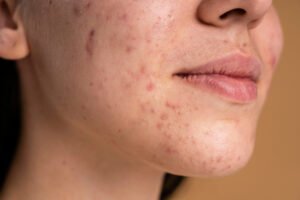 skin with clogged pores prone to acne