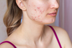femme ayant de l'acné 