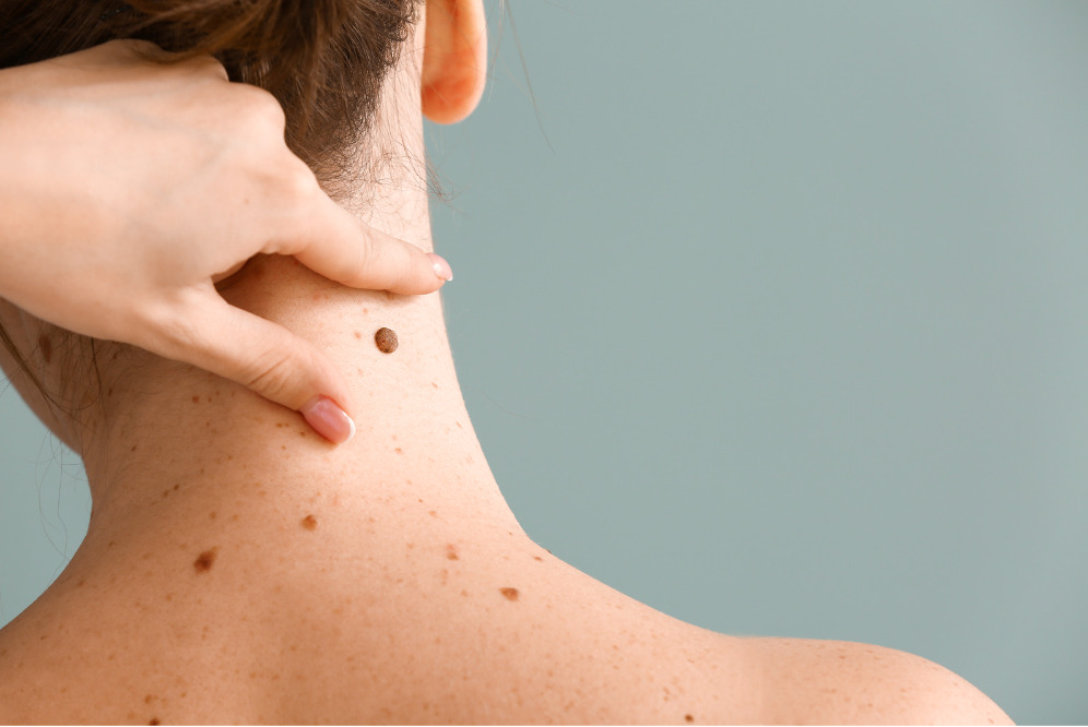 Person with back touching mole on shoulder, multiple freckles on skin.