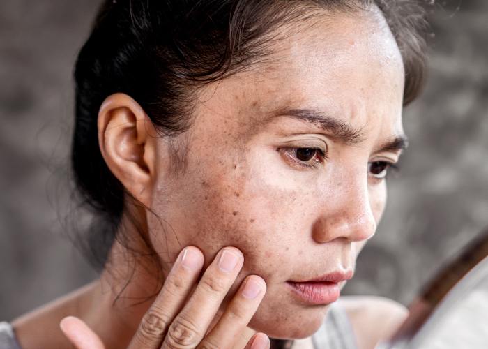 Les avantages d'un peeling chimique pour traiter les problèmes de peau - Perfect Skin