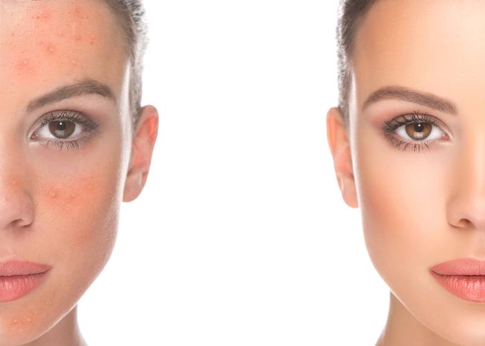 Les avantages d'un peeling chimique pour traiter les problèmes de peau - Perfect Skin